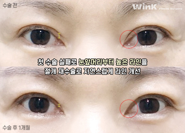 Improve Droopy Eyes with Wink Middle-Age Eyelid Surgery! image 10