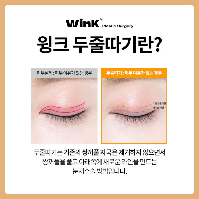 Shinsa Station Eye Revision Surgery: Lowering the Fold Line with the Double-Line Method image 2