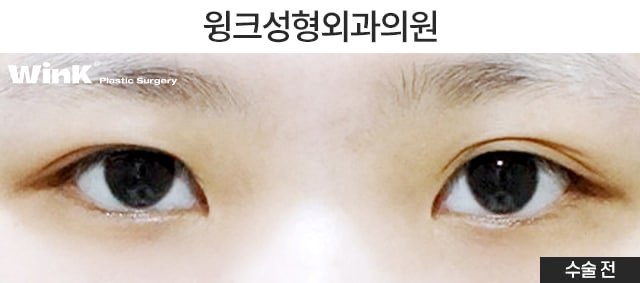 겹쌍꺼풀 해결 방법에 대해 알아보겠습니다. 관련 이미지 5