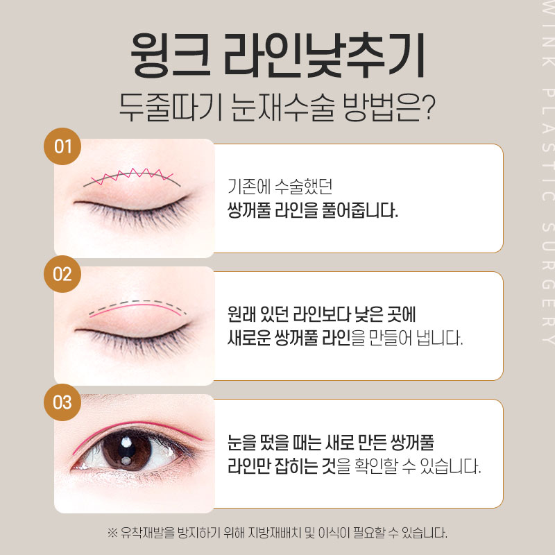 윙크성형외과 라인낮추기로 흉터 없이 원하는 쌍꺼풀 높이로! 관련 이미지 4