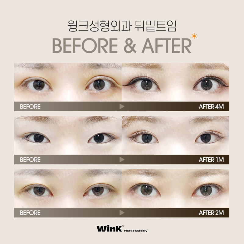Does Lateral Canthoplasty Always Reattach? How to Minimize Side Effects of Lateral Canthoplasty, as Explained by Wink Plastic Surgery! image 6