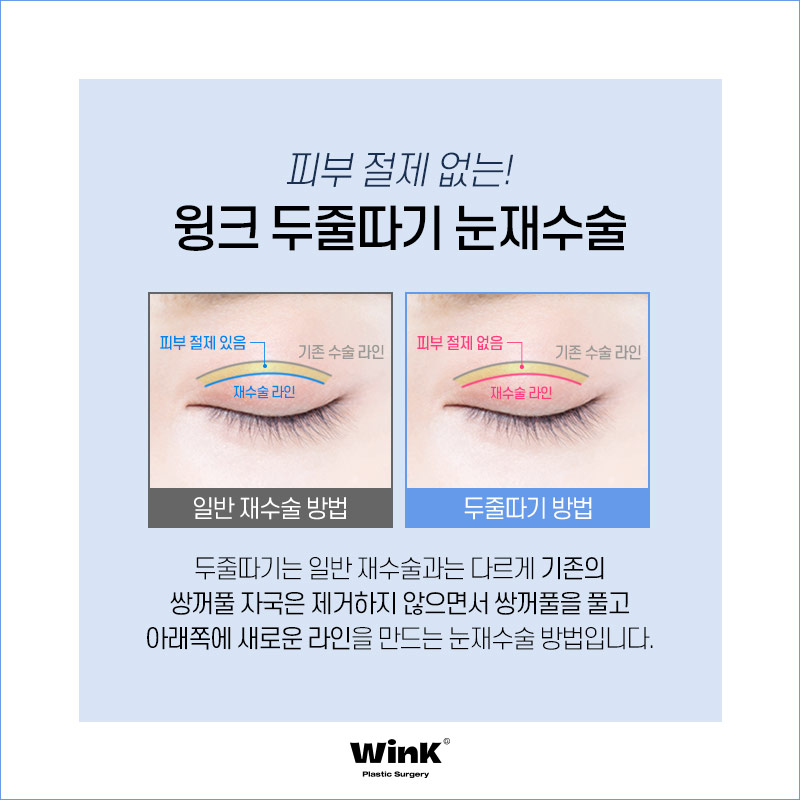 소세지눈? 윙크성형외과 두줄따기가 정답! 관련 이미지 7