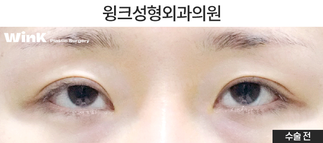 Let’s Take a Look at Double Eyelid Surgery for Droopy Eyes. image 2