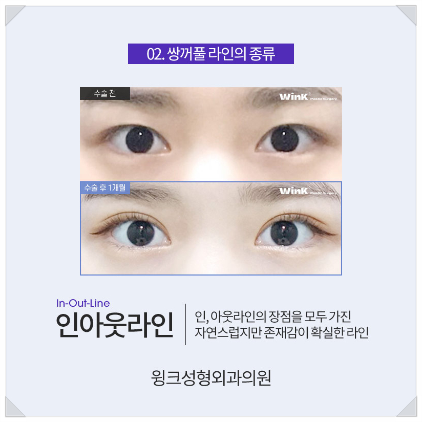 아이린눈 인아웃연예인?  윙크성형외과와 알아보는 쌍꺼풀라인종류! 관련 이미지 5