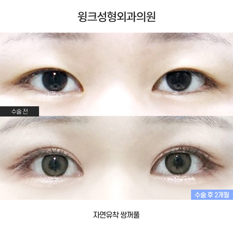 자연유착 쌍꺼풀에 대해 알아보겠습니다. 관련 이미지 1