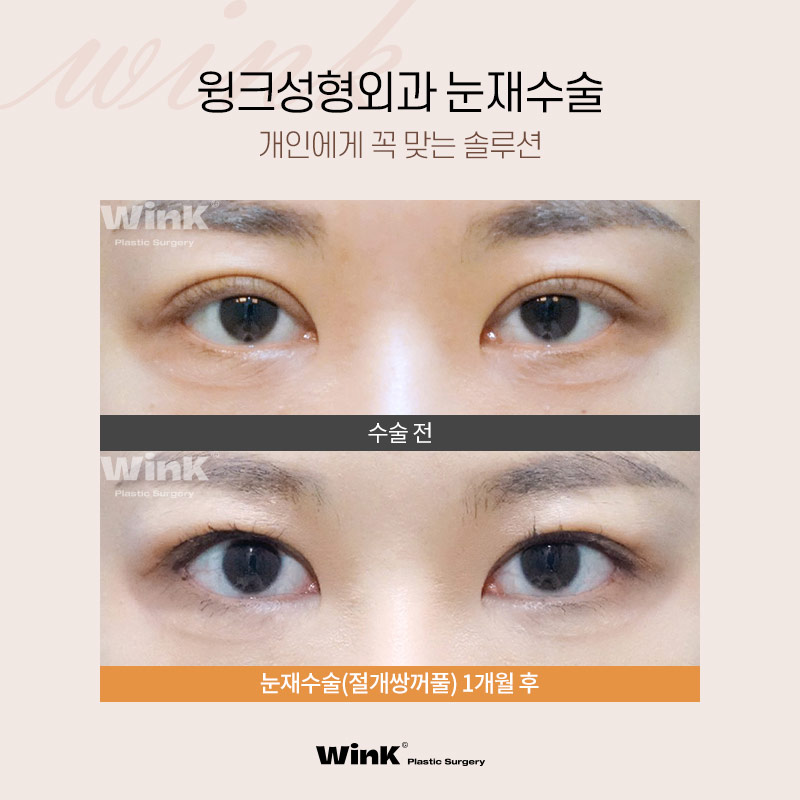 1차 수술 실패 원인 파악이 중요한 눈재수술, 윙크성형외과에서 정확하게 파악해 드려요! 관련 이미지 5