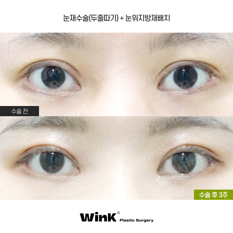 Are All Revision Eyelid Surgeries the Same? For High Crease "Sausage Eyes," Use Two-Line Technique to Lower the Front Line image 1