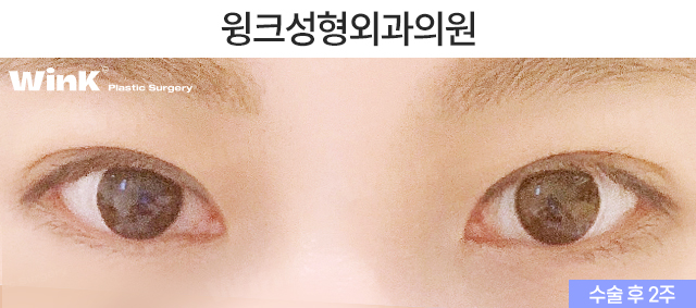 Let’s Learn About Double-Eyelid Revision Surgery with an Incision for a Thick Front Line image 3
