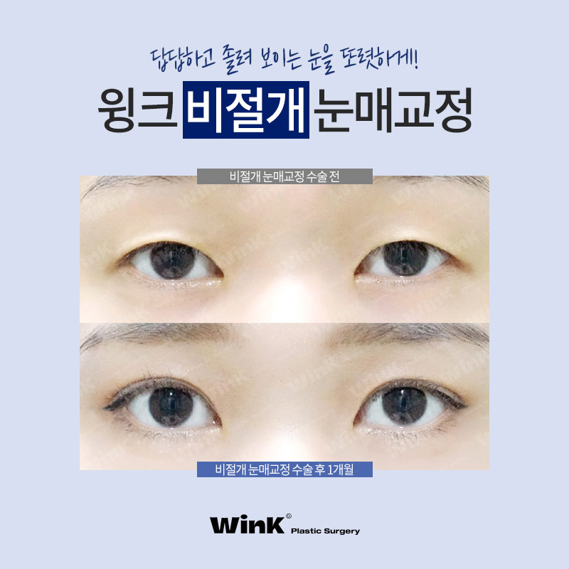 윙크성형외과 비절개 or 절개 눈매교정! 나에게 맞는 눈매교정은? 관련 이미지 5