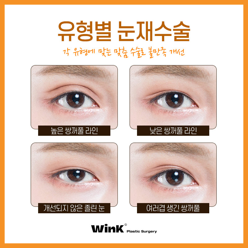 쌍꺼풀재수술 쌍수재수술후기 윙크성형외과 신사눈재수술비용 관련 이미지 3