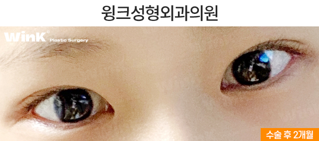 중학생 쌍커풀수술에 대해 알아볼까요? 관련 이미지 7