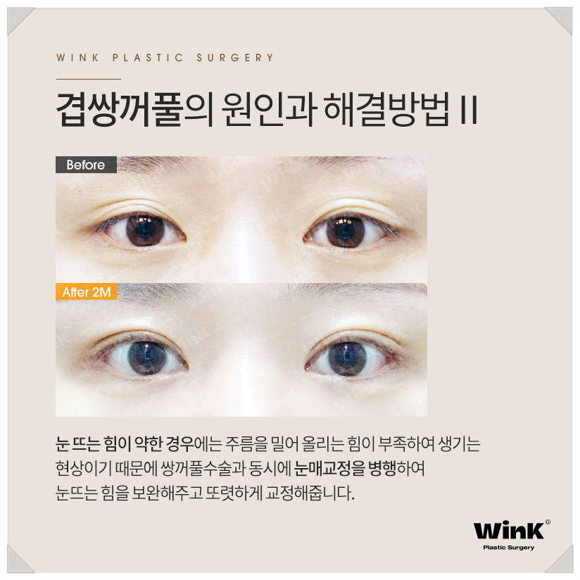 겹주름쌍꺼풀 쌍커풀여러겹 윙크성형외과  겹쌍 쌍커풀주름 관련 이미지 5