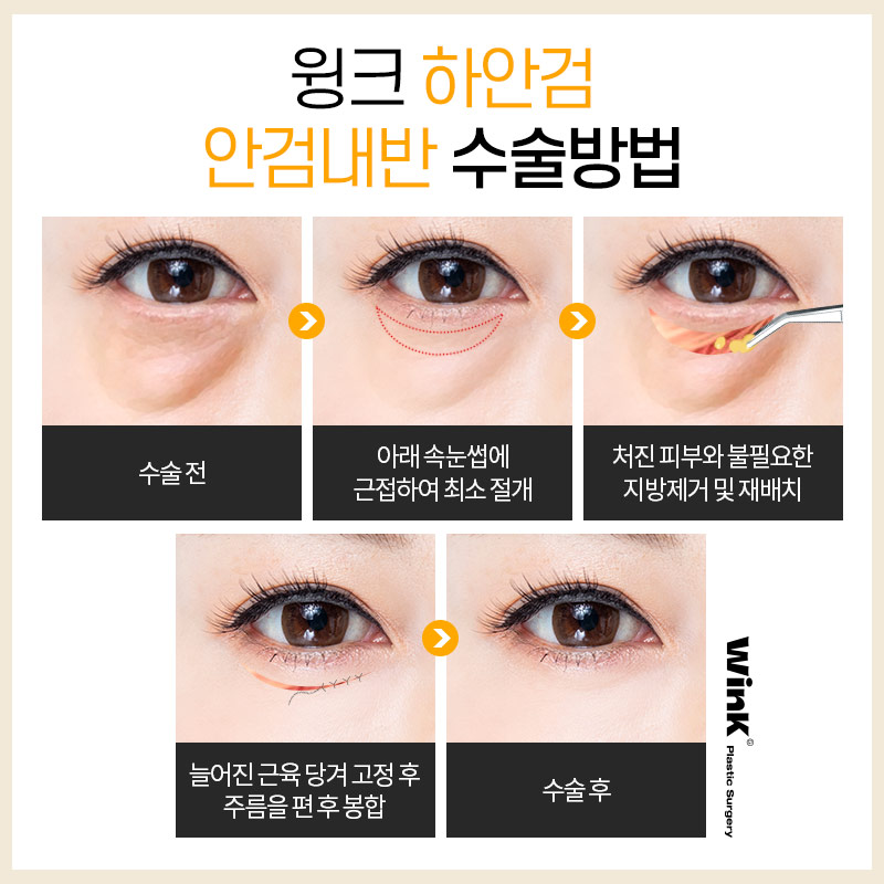If the lower eyelashes are poking your eyes? Solve it with lower blepharoplasty for entropion at Wink Plastic Surgery image 5