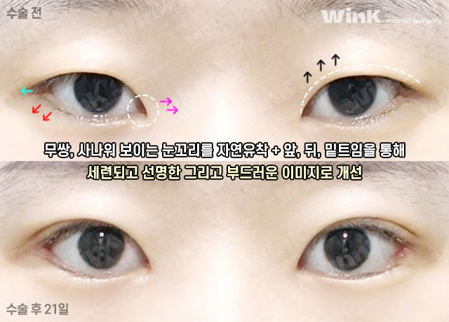자연스러운 쌍수 맛집 찾고 있다면 윙크성형외과 자연유착쌍꺼풀! 관련 이미지 4
