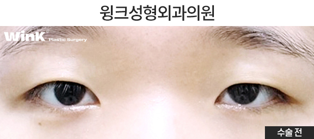 Should We Leave Eyelid Tape and Eyelid Glue Behind with Natural Adhesion Double Eyelid Surgery? image 2
