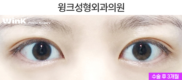 Shall We Take a Look at the Symptoms of Double Eyelid Loosening? image 6