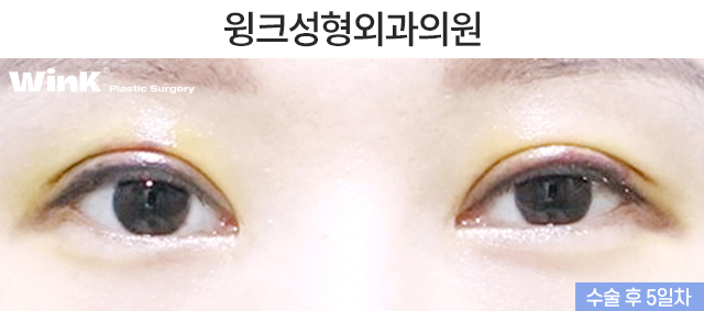 What Kind of Double Eyelids Suit Deep-Set Eyes? image 6
