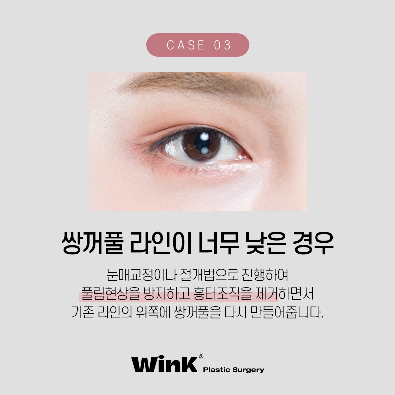 소세지눈재수술 생각한다면? 윙크성형외과 신사역쌍꺼풀재수술 관련 이미지 5