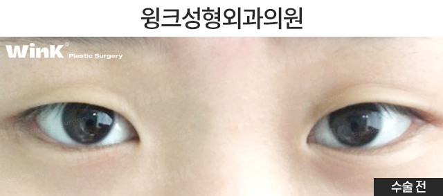 중학생 쌍커풀수술에 대해 알아볼까요? 관련 이미지 2