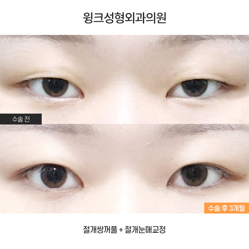 절개 쌍꺼풀 수술법에 관해 알아보겠습니다. 관련 이미지 1