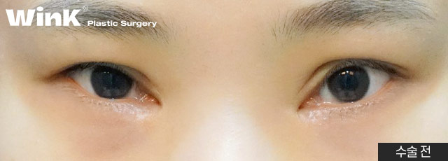 Wink canthoplasty and lower canthoplasty to overcome a cramped-looking eye shape! image 9