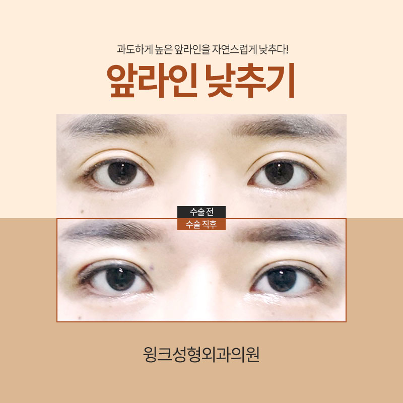 앞쪽이 두꺼운 아웃라인 쌍꺼풀, 해결 방법은? 관련 이미지 4