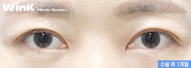 Improve Droopy Eyes with Wink Middle-Age Eyelid Surgery! image 4