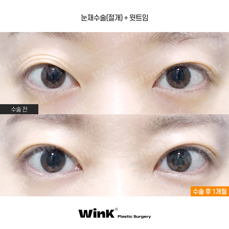 윙크성형외과에서 알려드리는 적절한 눈재수술 시기 관련 이미지 1
