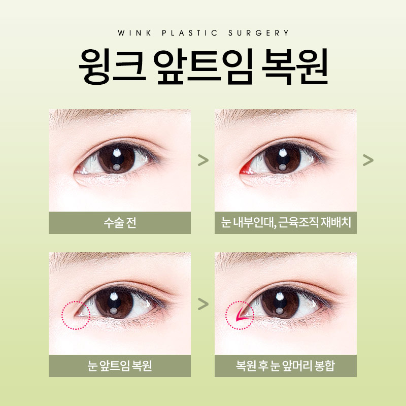 미세한 차이로 달라진 인상, 신사앞트임복원수술로 시원한 눈매로 관련 이미지 3