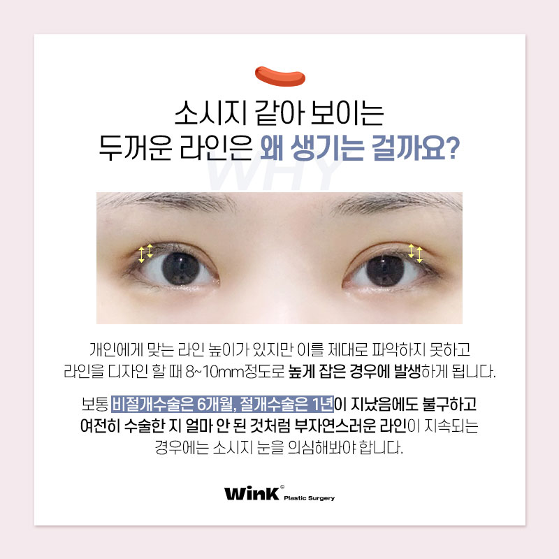 Thick, High Double Eyelid Lines and a Sausage-Like Eye! Solve It with Wink Double-Line Revision Surgery! image 2