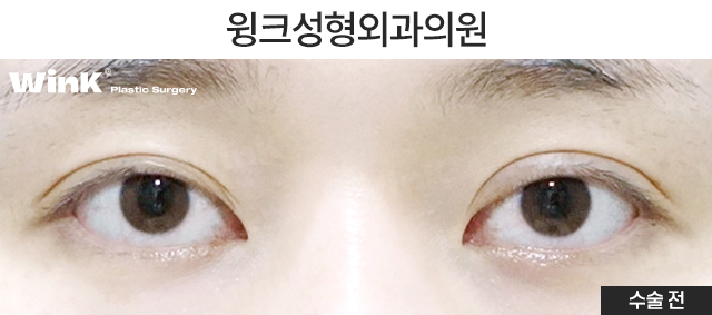 Shall We Learn About the Skin-Preserving Incision Method for Double-Line Reduction? image 5
