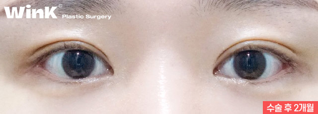 Wink canthoplasty and lower canthoplasty to overcome a cramped-looking eye shape! image 4