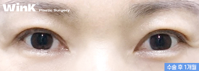 Improve Droopy Eyes with Wink Middle-Age Eyelid Surgery! image 7
