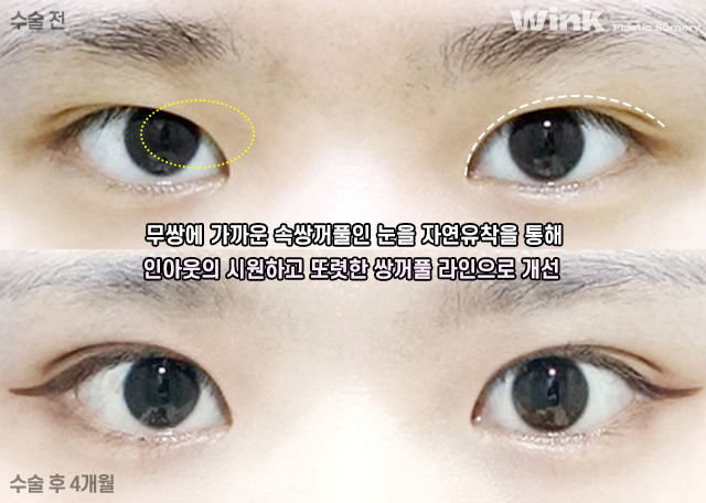 Let’s Learn About Before and After Natural Adhesion Double Eyelid Surgery image 4