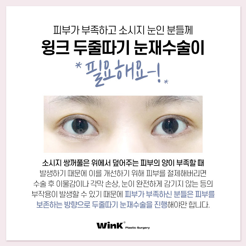 Thick, High Double Eyelid Lines and a Sausage-Like Eye! Solve It with Wink Double-Line Revision Surgery! image 5