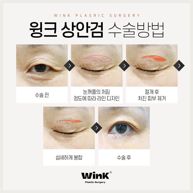 Sagging Eyelids That Have Lost Elasticity: A Youthful Eye Look with Upper Blepharoplasty at Wink Plastic Surgery image 3