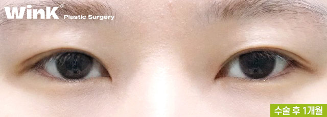 Non-incisional Eye Correction Review: A Natural, Clear Eye Shape! image 4