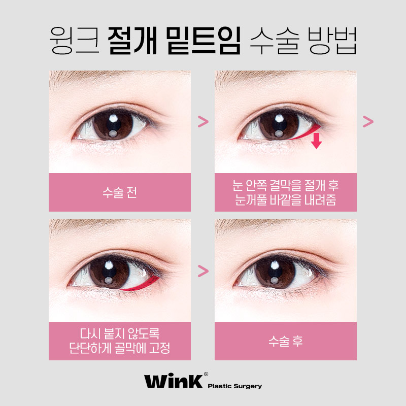 신사트임잘하는곳?  윙크성형외과 절개뒤밑트임후기! 관련 이미지 5