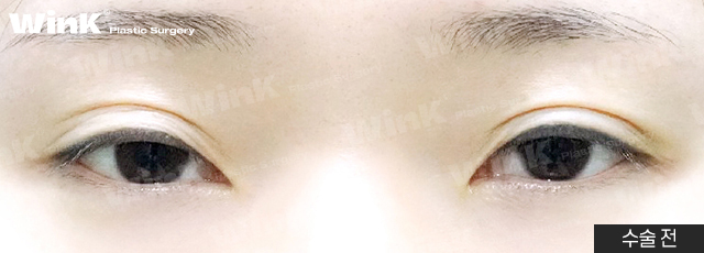 Lowering the Double Eyelid Line: Making Thick Double Eyelids (Sausage Eyes) Look Natural with a Two-Line Revision Surgery! image 2