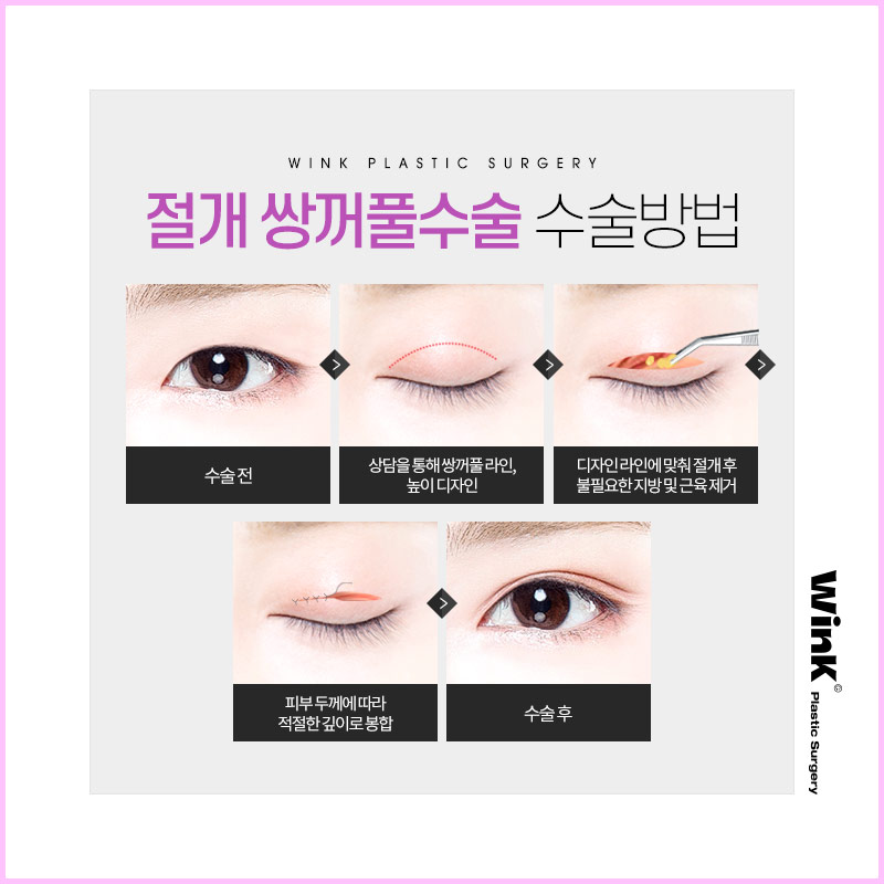If you want to create the double eyelid line you want without being limited by your eye shape, Wink Incision Double Eyelid Surgery! image 5