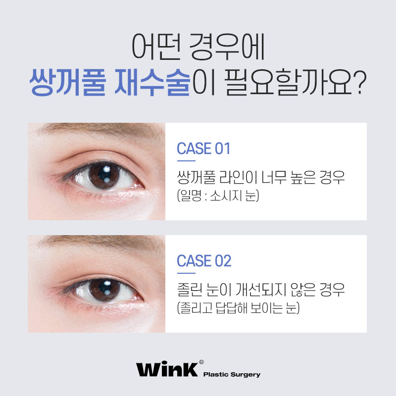 마지막 눈재수술을 위한 선택! 윙크성형외과 눈재수술 관련 이미지 3