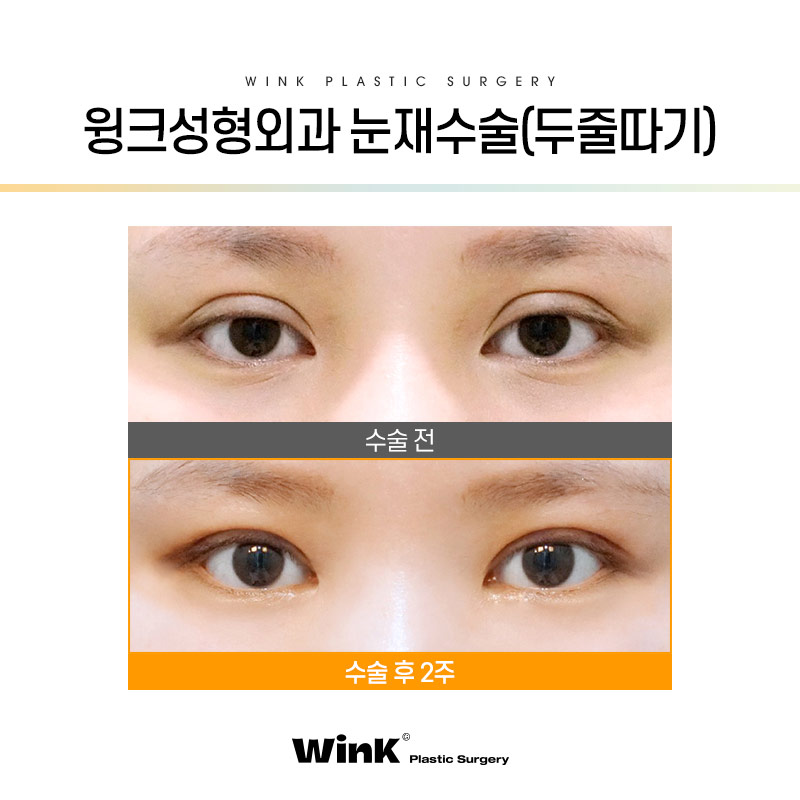 절개쌍꺼풀잘하는곳 눈수술후관리 윙크성형외과에서 눈성형 궁금증 풀어드려요 관련 이미지 8