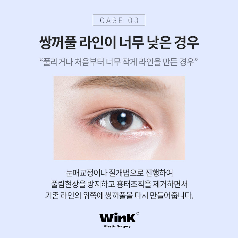 Types of Double Eyelid Revision Surgery and Solutions at Wink Plastic Surgery, Sinsa Station image 5