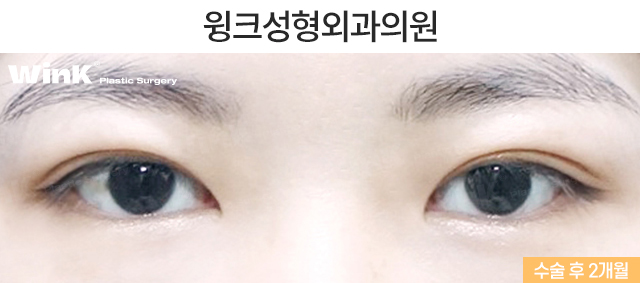 Let’s Learn About Incisional Double Eyelid Surgery. image 3