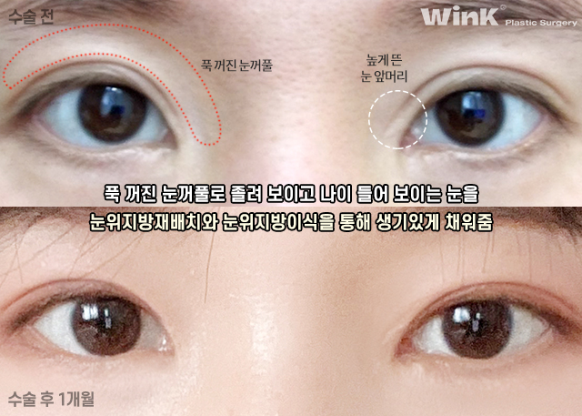 What Kind of Double Eyelids Suit Deep-Set Eyes? image 4