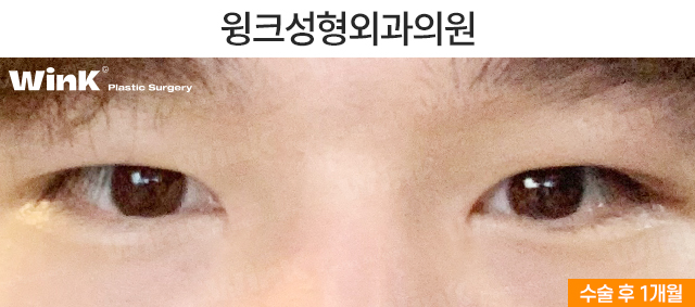 남자 속쌍커풀 수술에 대해 알아보자 관련 이미지 3