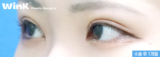 The Key to Ptosis Correction Is Proper Iris Exposure! image 6