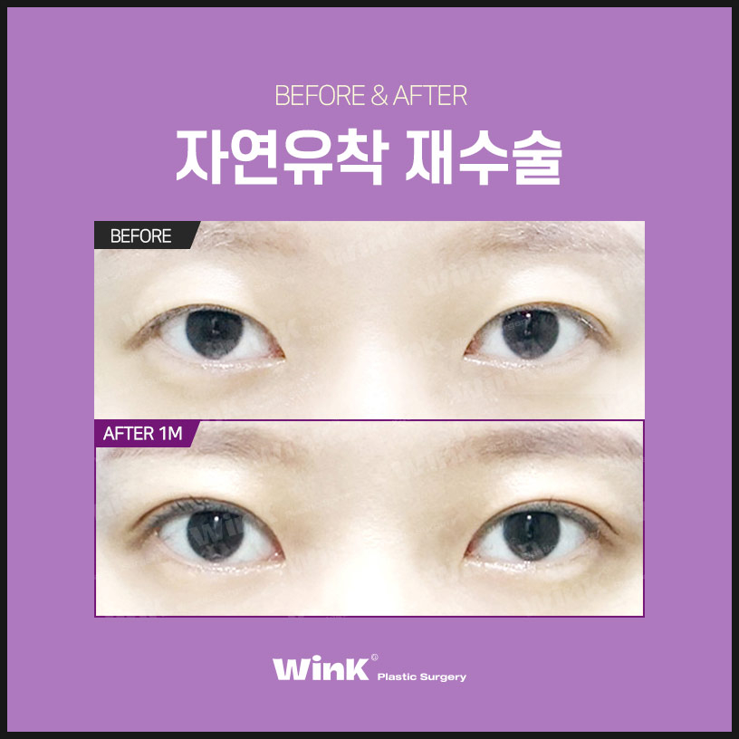 자연유착재수술 쌍수재수술 윙크성형외과 쌍꺼풀재수술 쌍꺼풀재수술후기 관련 이미지 7