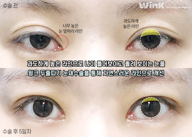 Let’s Learn About Double-Eyelid Revision Surgery with an Incision for a Thick Front Line image 5