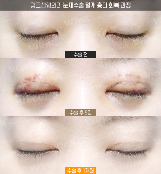윙크성형외과에서 알려드리는 적절한 눈재수술 시기 관련 이미지 6